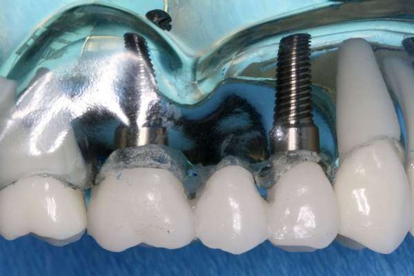 Refaire Ses Dents : Les 10 Techniques Expliquées Par Le Dr. Zisserman