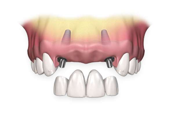 Solutions pour remplacer une dent manquante (dent provisoire