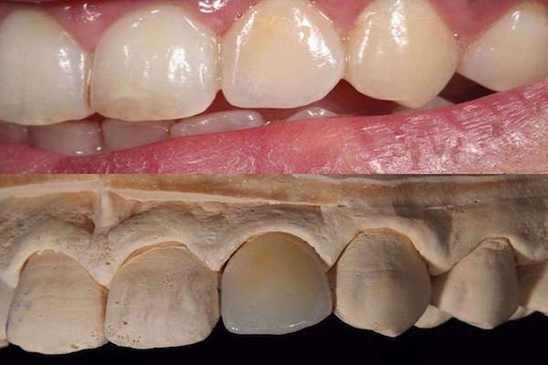 Peut-on accepter de couronner une dent saine ? – L'Information Dentaire