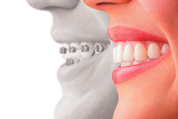 2 Paires Faux Dentier, Dent Provisoire Fausse Dent Dentier Amovible Haut Et  Bas, Facette Prothese Dentaire, Fausses Dents Alternatives Au Blanchiment