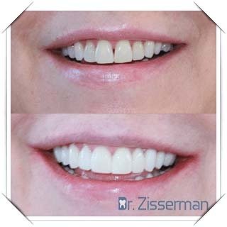 https://drzisserman-chirurgien-dentiste.fr/assets/img/cas/facette-dentaire-blanchiment.jpg