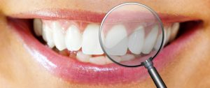 Facette dentaire : comment avoir un sourire sublime