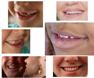 Facette dentaire pour un sourire parfait