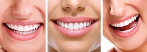 Facette dentaire : pour retrouver un sourire sublime