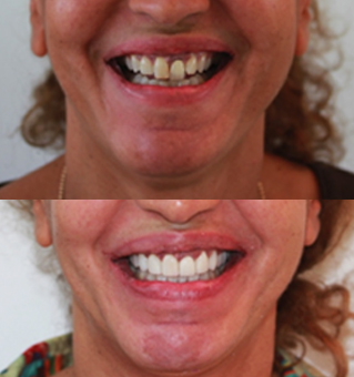 Facette Dentaire : Le Guide Complet Par Dr. Zisserman