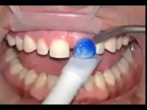 La Facette dentaire : Prix et Remboursement