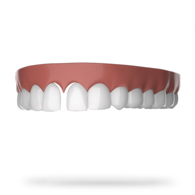 Dentier dents écartées