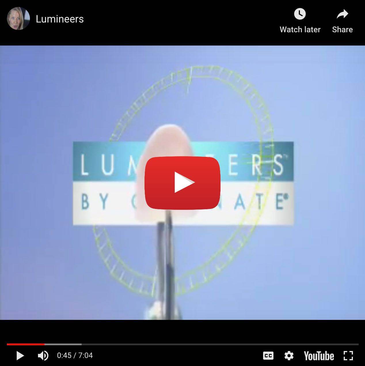Vidéo de présentation des facettes dentaires Lumineers