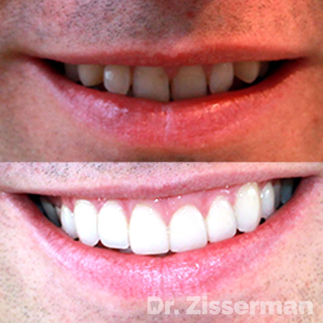 Refaire Ses Dents Les 10 Techniques Expliquées Par Le Dr. Zisserman Refaire Ses Dents Les 10 Techniques Expliquées Par Le Dr. Zisserman