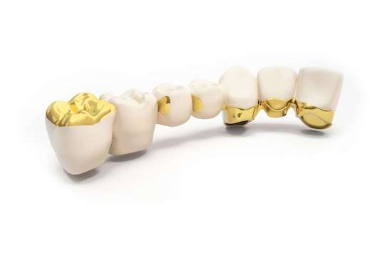 refaire dents bridge ceramo metallique