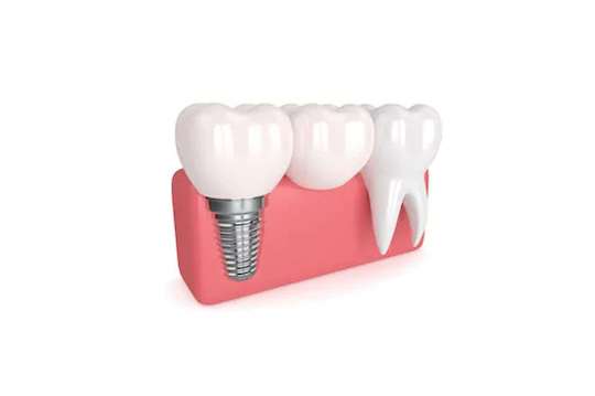 refaire dents bridge implant