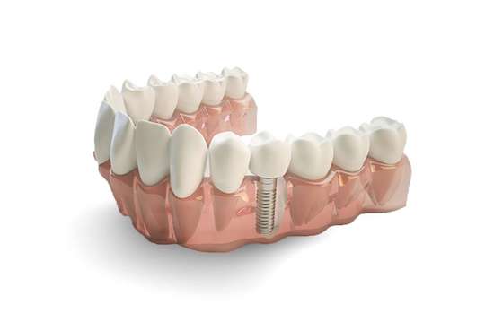 refaire dents couronne implant
