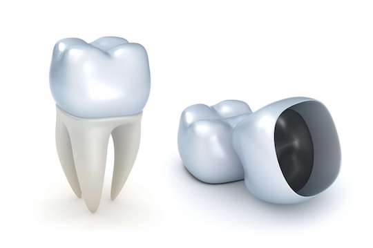 refaire dents couronne