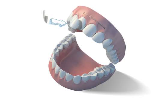 refaire dents facette pelliculaire