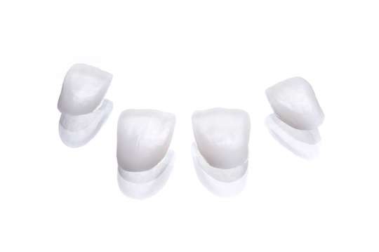 refaire dents facette prefabriquee