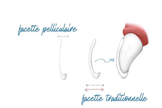 refaire dents facette traditionnelle